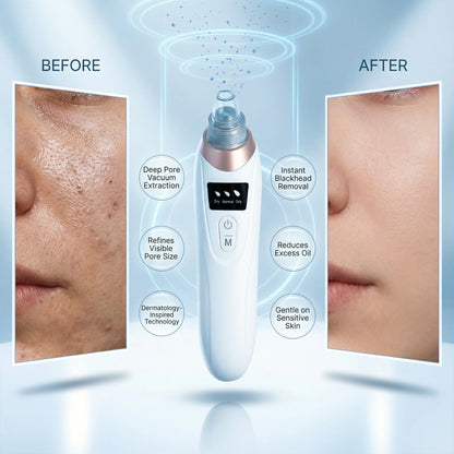 ®Oligama Pro – Siyah Nokta ve Gözenek Temizleme Cihazı